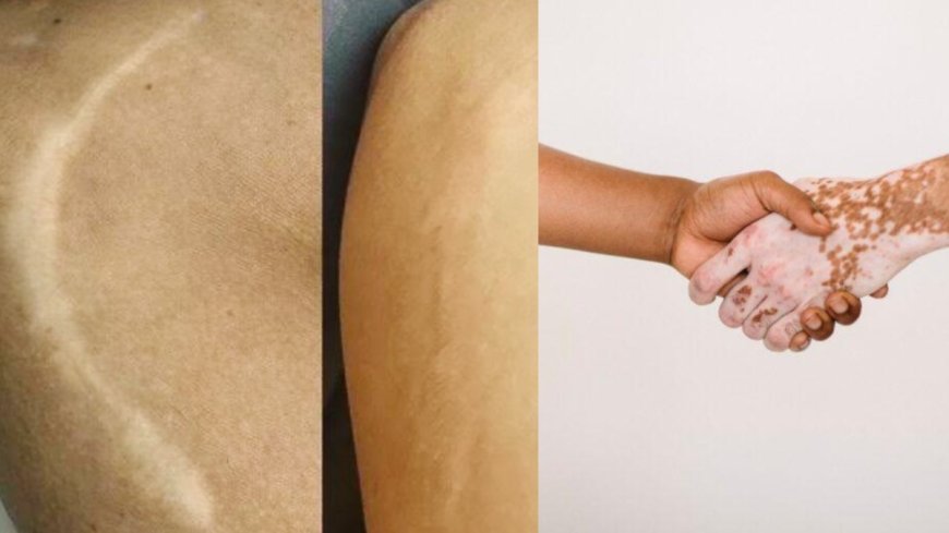 Scar and Vitiligo Treatment in Mumbai, Vitiligo and Scar Treatment Clinic in Mumbai – BrowMaster