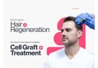 New Frontiers in Hair Regeneration: The Rise of Cell-Based Therapies